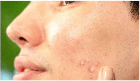 everything you need to know about acne scarring