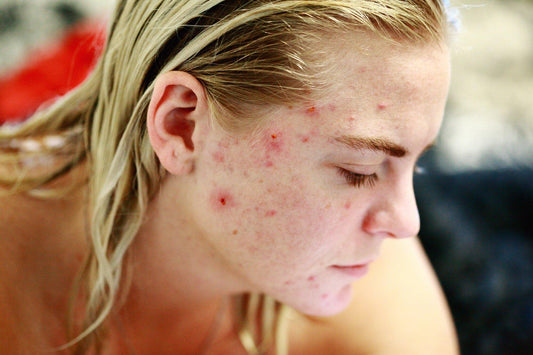 Best Vitamins for Skin Breakouts